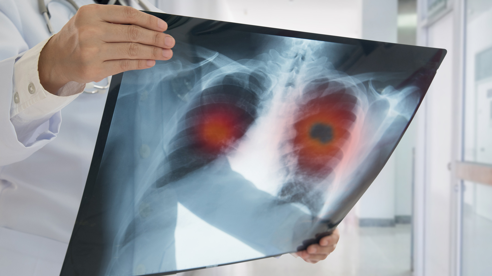 Sàng lọc ung thư phổi nên dành cho người trưởng thành có nguy cơ cao