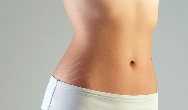 9 cách chữa rạn da cho chị em phụ nữ
