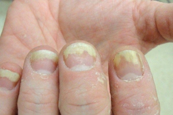 c1f0e64ee6c4245358b07a783e0e3429-disorders-nail-care-tips-1626506940.jpg