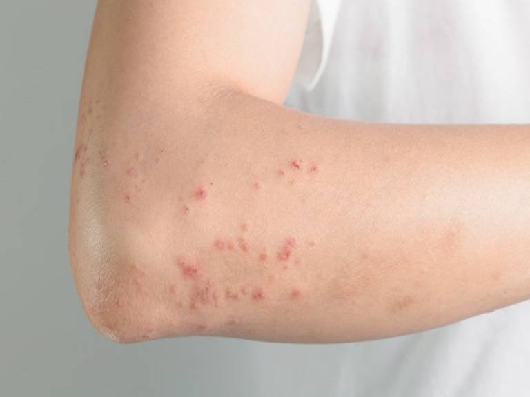 Ăn thịt lợn chưa nấu chín có nguy cơ nhiễm giun sán
