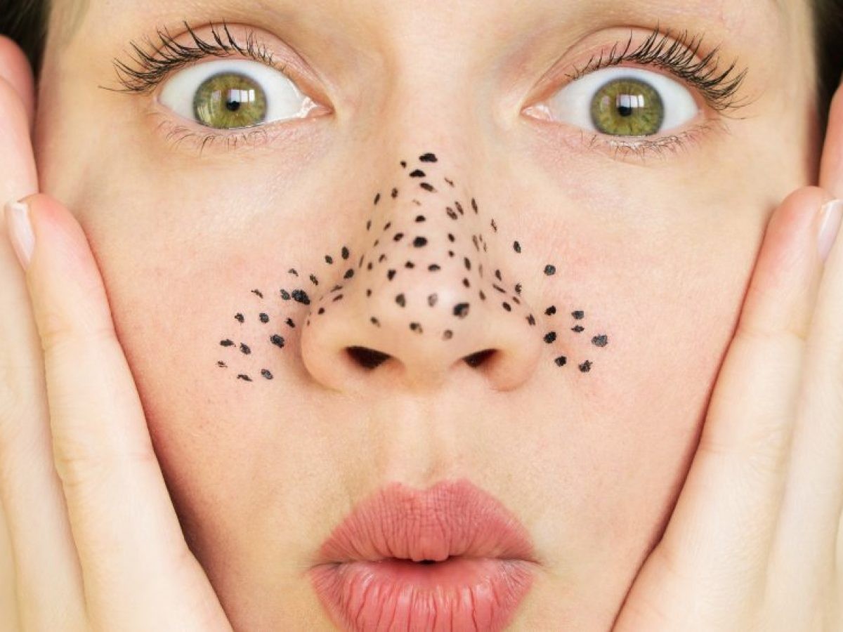 Những cách giản đơn giúp điều trị mụn đầu đen tại nhà