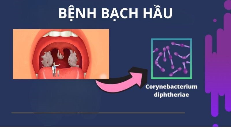 Triệu chứng và cách phòng tránh bệnh bạch hầu