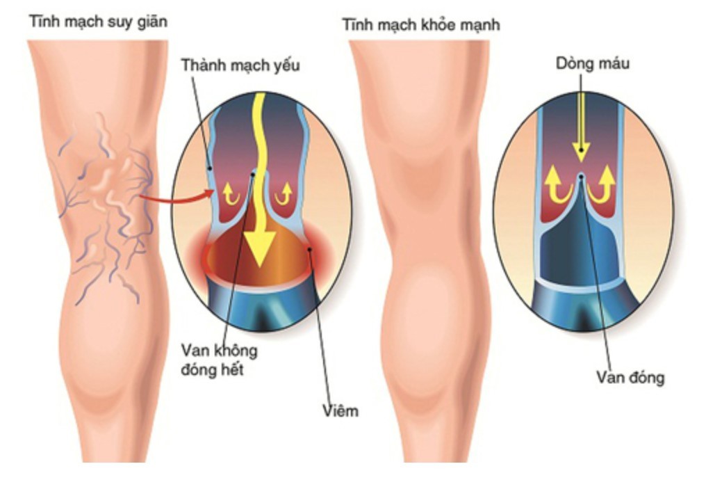 Nhóm thuốc điều trị suy giãn tĩnh mạch hiện nay