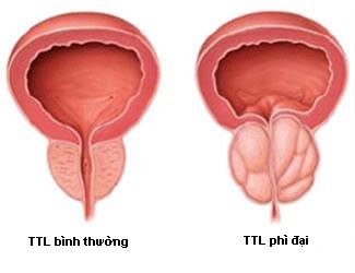 Phì đại tiền liệt tuyến: nguyên nhân, triệu chứng và cách xử lý