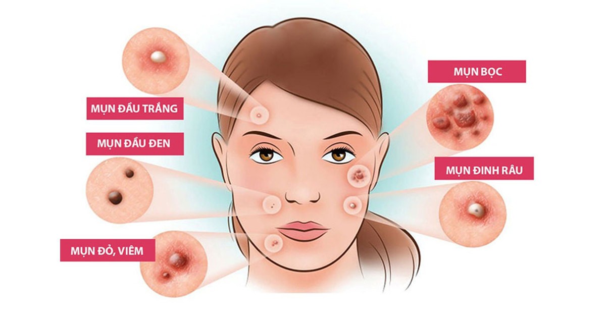 7 loại thực phẩm càng ăn, da bạn càng trở nên nhiều mụn