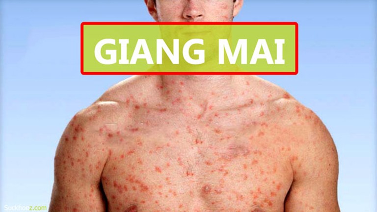 Những dấu hiệu của bệnh giang mai