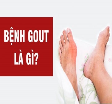Đau khớp dữ dội có phải là triệu chứng bệnh Gout?
