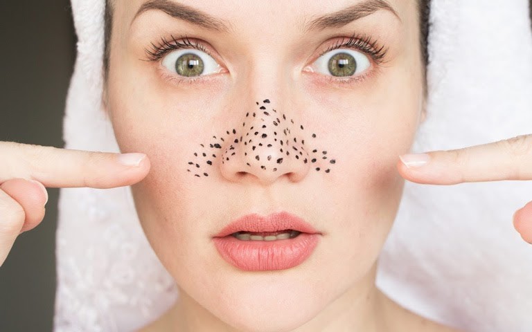 5 việc làm tưởng chừng vô hại những lại là nguyên nhân nổi mụn đầu đen