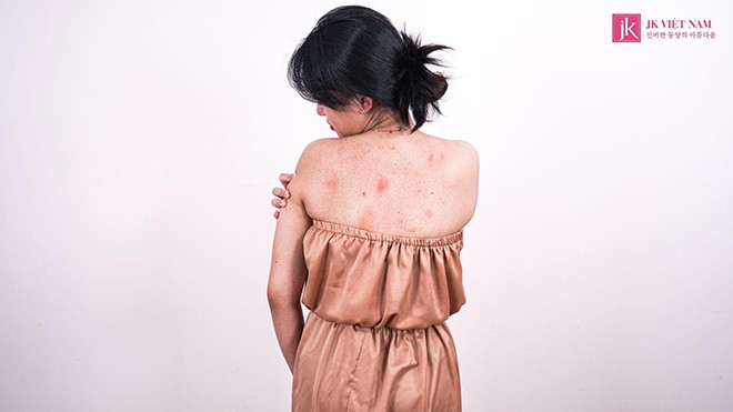 Mụn nhỏ nổi khắp người là dấu hiệu của bệnh viêm nang lông