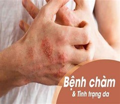 Bệnh chàm nếu không được chữa trị kịp thời có thể gây viêm da