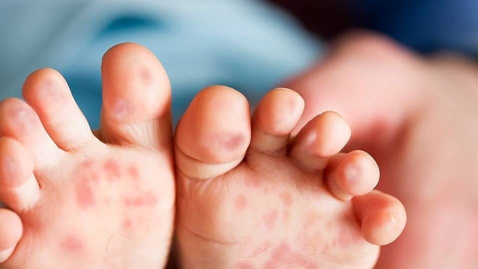 Cách phòng ngừa bệnh tay, chân, miệng ở trẻ em