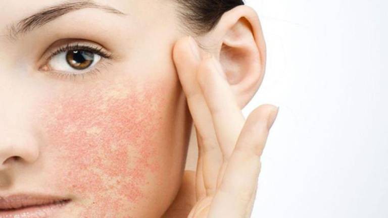Cách chữa trị và chăm sóc da khi bị kích ứng mỹ phẩm