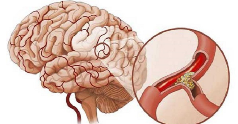Cách người Nhật phòng ngừa tai biến do mỡ máu trong bữa ăn hằng ngày