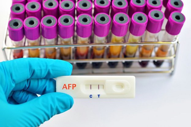 Vì sao bệnh nhân viêm gan B phải xét nghiệm alpha-fetoprotein?