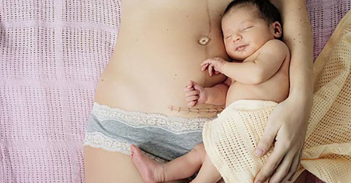Chùm ảnh chân thật về những vết rạn sau sinh khiến ai nhìn vào cũng phải xót xa vì sự tàn phá kinh khủng đối với cơ thể phụ nữ