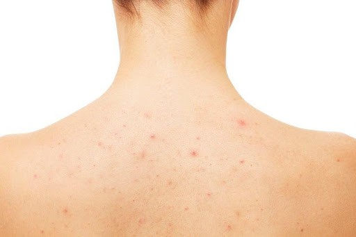 Tạm biệt mụn lưng bằng những nguyên liệu có sẵn trong nhà bếp