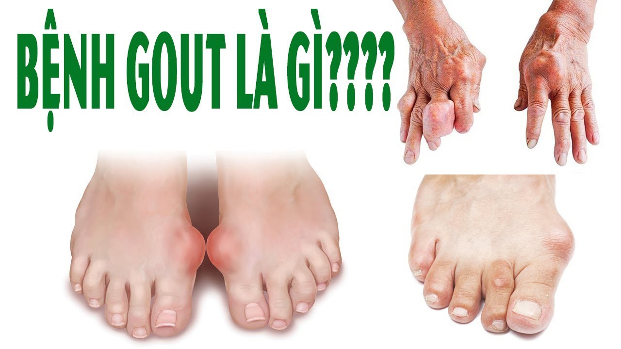 Những dấu hiệu cho thấy bạn đã bị bệnh gút