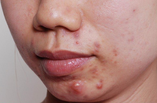 Mụn nội tiết: Dấu hiệu nhận biết và các thực phẩm nên ăn để nhanh chóng xóa sạch