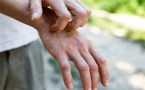Anh phát hiện dấu hiệu lạ trên da của nhiều bệnh nhân Covid-19
