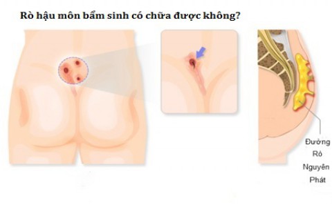 Nguyên nhân rò hậu môn tái phát?