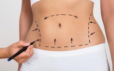 Hút mỡ có tổn thương cơ thể? Lưu ý cho bạn sau khi phẫu thuật