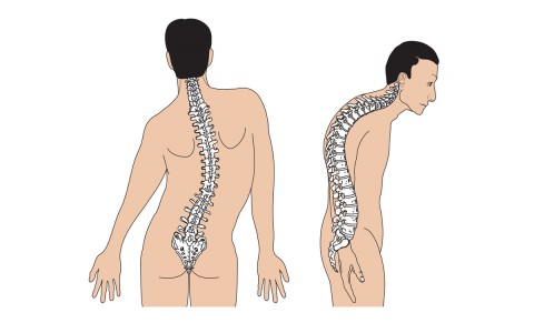 Yếu tố nào gây nên chứng vẹo cột sống ở trẻ?