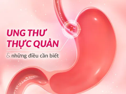 Nguy cơ gây ung thư thực quản vì thói quen ăn uống đồ quá nóng