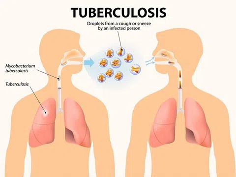 Tăng cường các giải pháp nhằm chấm dứt bệnh Lao vào năm 2030