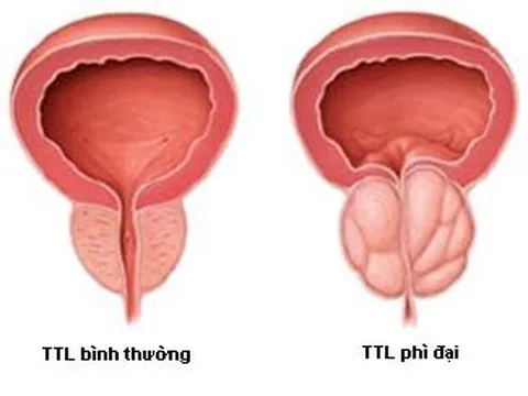 Phì đại tiền liệt tuyến: nguyên nhân, triệu chứng và cách xử lý