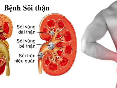 Nếu bạn đang bị thận thì hãy áp dụng những phương pháp sau!