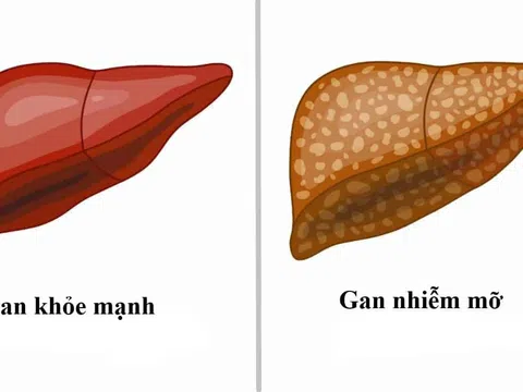 Bệnh gan nhiễm mỡ: Nên tránh những loại thực phẩm nào?