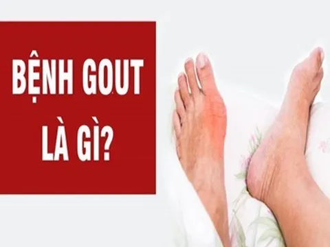 Đau khớp dữ dội có phải là triệu chứng bệnh Gout?
