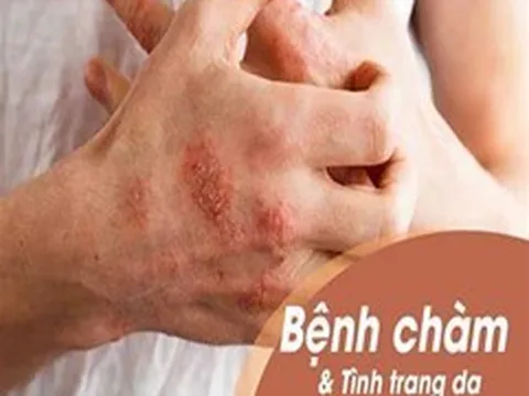 Bệnh chàm nếu không được chữa trị kịp thời có thể gây viêm da