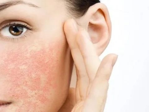 Cách chữa trị và chăm sóc da khi bị kích ứng mỹ phẩm
