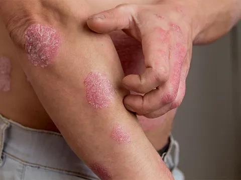Những thực phẩm "nên và không nên" sử dụng dành cho người mắc bệnh vẩy nến