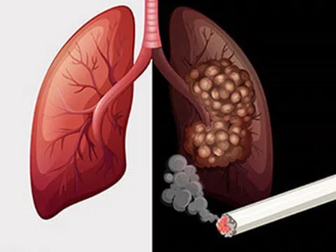 Hút thuốc suốt một năm, phổi của bạn bị tổn hại đến mức không tưởng tượng nổi!