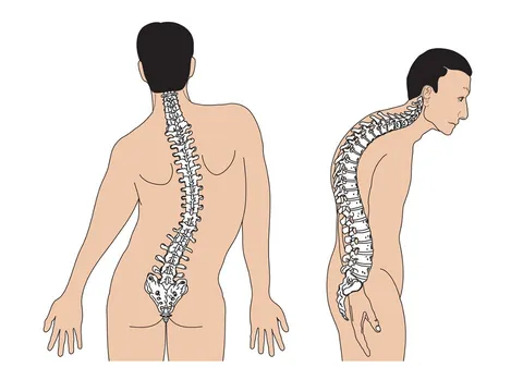 Yếu tố nào gây nên chứng vẹo cột sống ở trẻ?