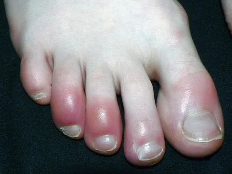 Bệnh cước tay chân mùa đông và những cách chữa trị hiệu quả